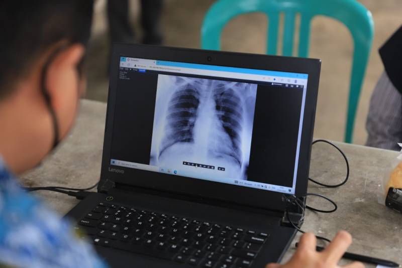 Deteksi Dini Tuberkulosis, Dinkes Kota Tangerang Gencarkan Skrining dengan Portabel X-ray